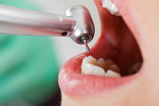 Best Emergency Wisdom Teeth Removal in Butler, WI